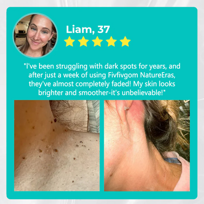 ✅ Official Store: Rolimey® NatureErase Instant Alligator Oil Mole & Spot Removal Plus Gel