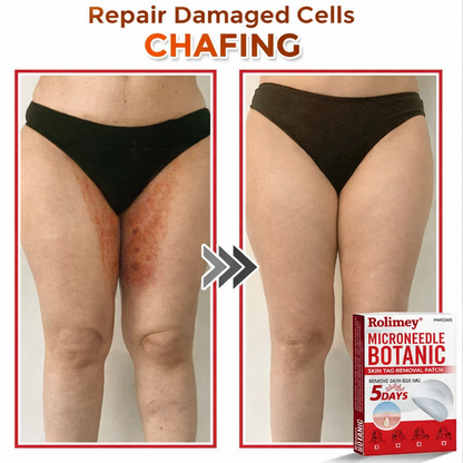 🌈Rolimey® MicroNeedle Botanic Skin Tag Removal Patch 🇺🇸 Made in the USA