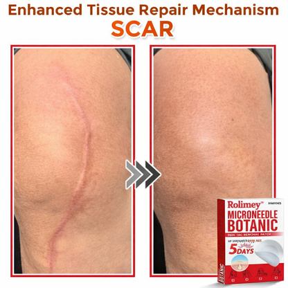 🌈Rolimey® MicroNeedle Botanic Skin Tag Removal Patch 🇺🇸 Made in the USA