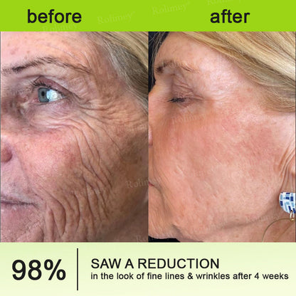 🌹Made and shipped from the CA 💫Rolimey® Botox & Vita-A Retinol Shot Wrinkle-Lift Tightening cream - Last Day Promotion 70% OFF