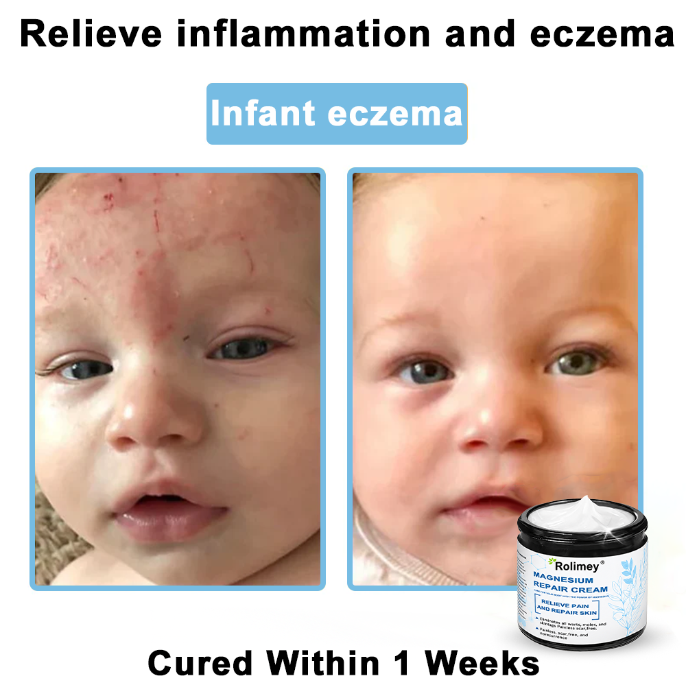 ✅Official Store: Rolimey® Magnesium skin repair cream
