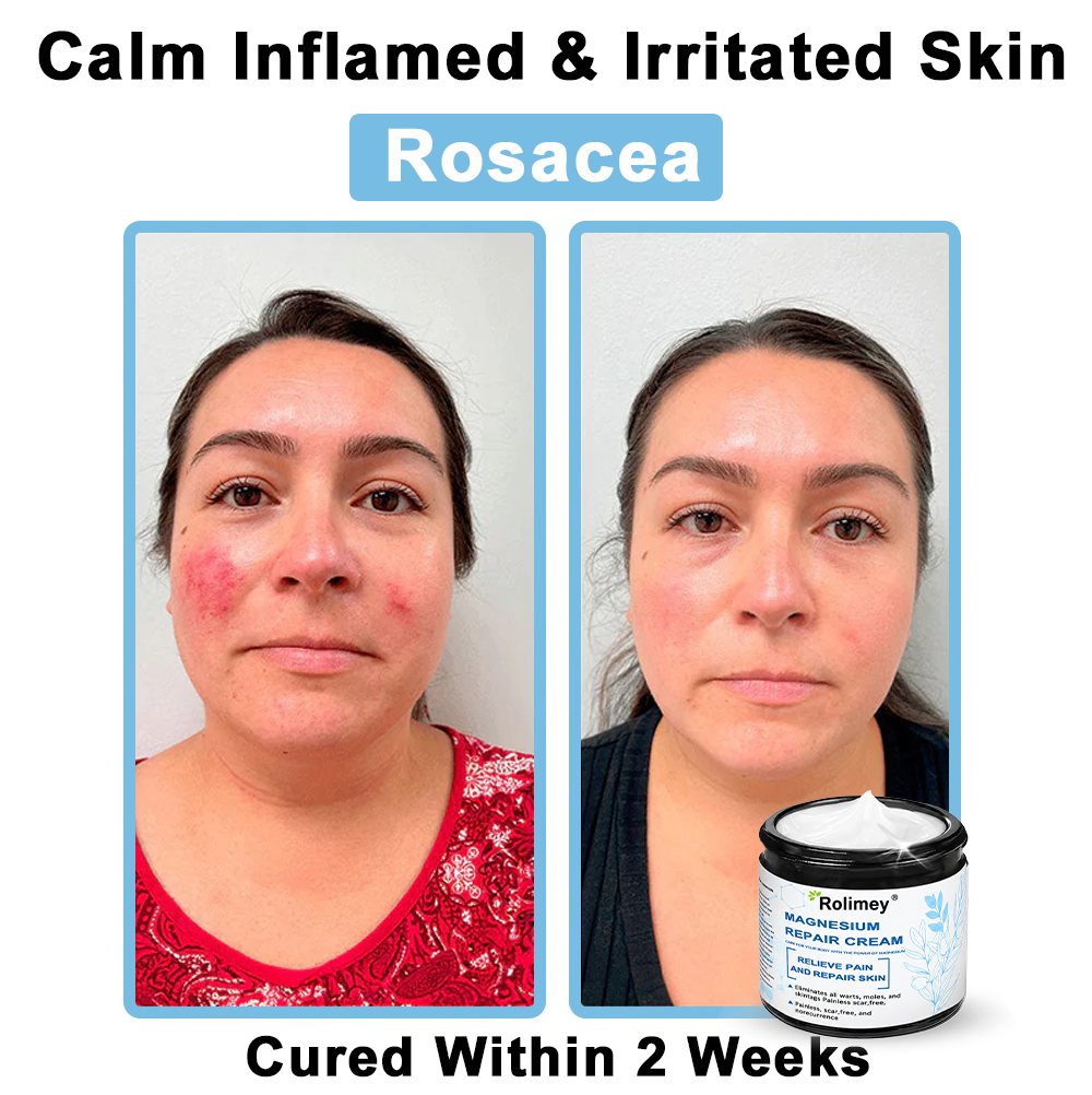 ✅Official Store: Rolimey® Magnesium skin repair cream