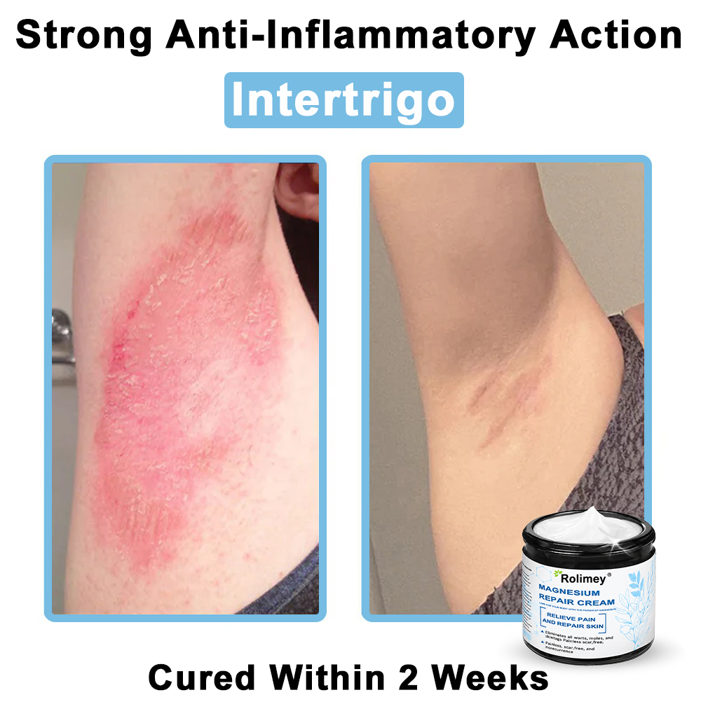 ✅Official Store: Rolimey® Magnesium skin repair cream