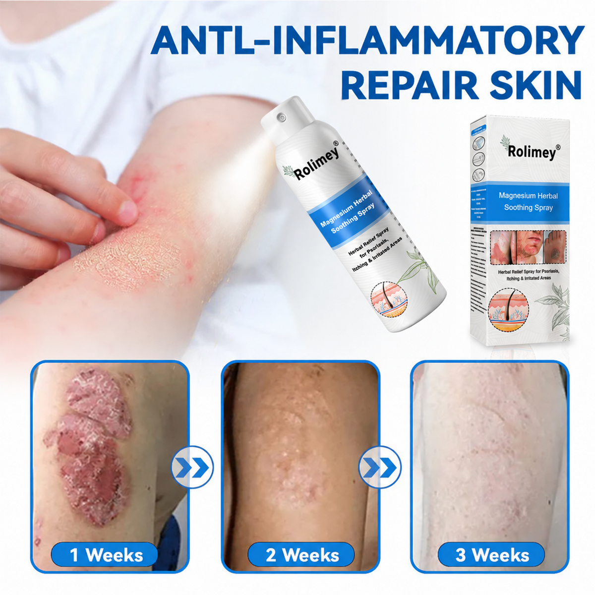 💯Official Store: Rolimey®Magnesium Herbal Psoriasis Spray⚕️Health Canada Certified (Relief for Psoriasis and Eczema, Improvement of Bacterial Infections in the Genital Area, Elieves joint pain and neuropathic pain)