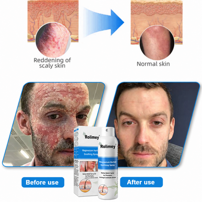 ✅Official Store: Rolimey®Magnesium Herbal Psoriasis Spray⚕️Health Canada Certified (Relief for Psoriasis and Eczema, Improvement of Bacterial Infections in the Genital Area, Elieves joint pain and neuropathic pain)