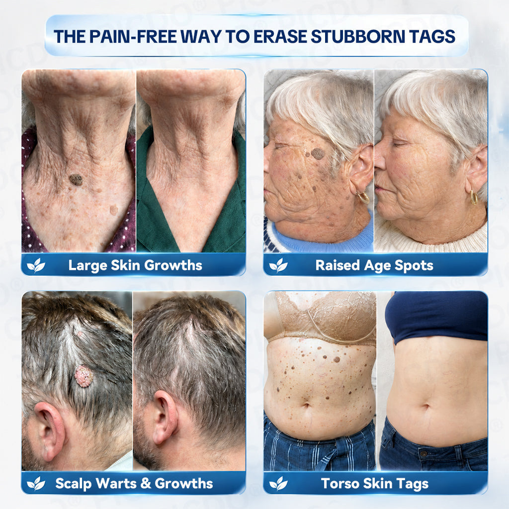 🧩Official Brand Shop |  GFOUK® 7-𝐃𝐚𝐲 𝐒𝐤𝐢𝐧 𝐓𝐚𝐠 & 𝐒𝐩𝐨𝐭 𝐄𝐫𝐚𝐬𝐞𝐫 𝐂𝐫𝐞𝐚𝐦 (Zero Pain, Zero 𝐒𝐜𝐚𝐫𝐬 Formula)