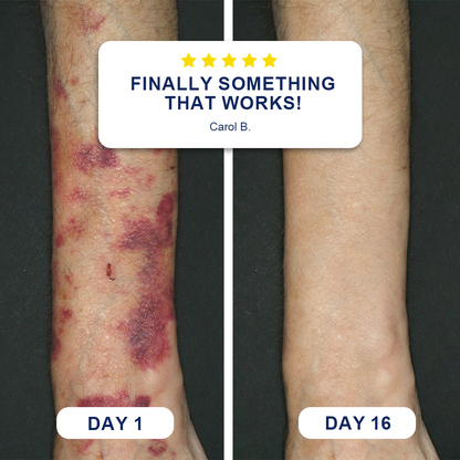 👨‍⚕️Over 100,000 units sold💕-🗽Evolvion® Bruise Repair & Skin-Strengthening Cream