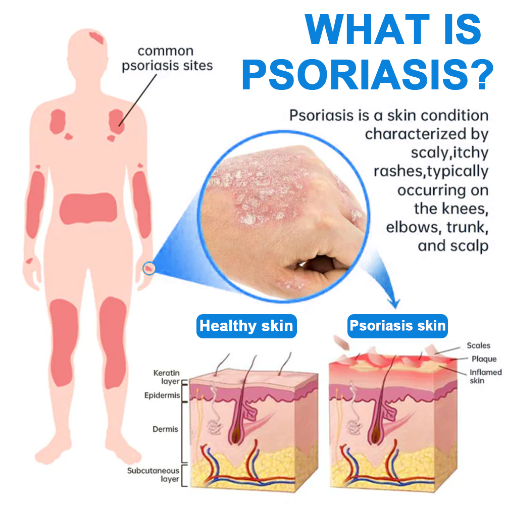 💯Official Store: Rolimey®Magnesium Herbal Psoriasis Spray⚕️Health Canada Certified (Relief for Psoriasis and Eczema, Improvement of Bacterial Infections in the Genital Area, Elieves joint pain and neuropathic pain)