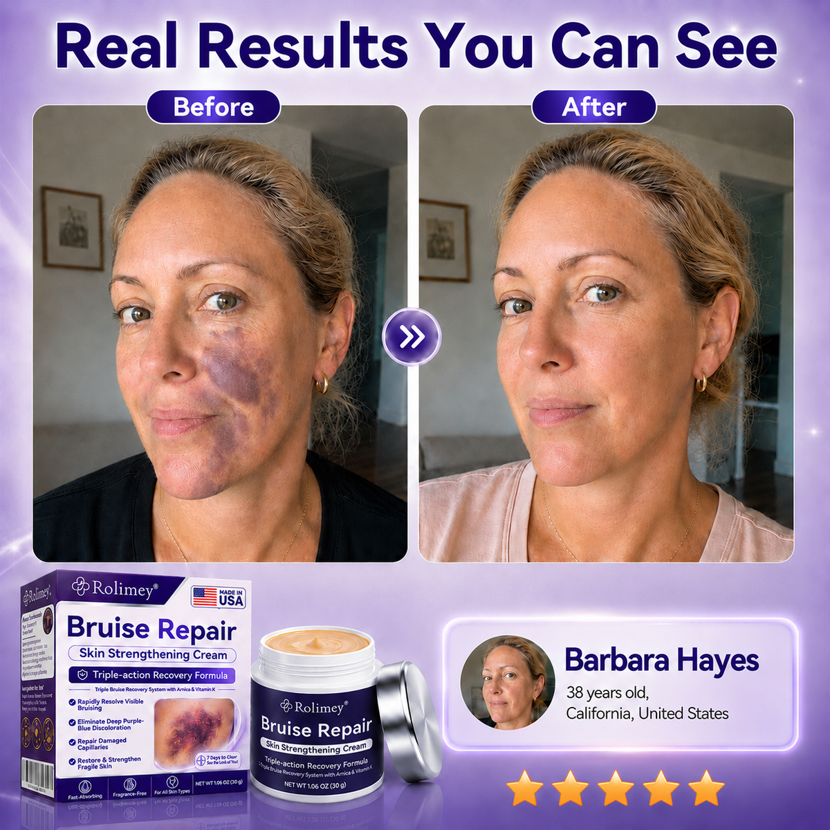 👨‍⚕️Over 100,000 units sold🔥 - Rolimey® cream to repair bruises and strengthen the skin.
