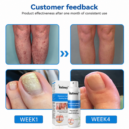 ✅Official Store: Rolimey®Magnesium Herbal Psoriasis Spray⚕️Health Canada Certified (Relief for Psoriasis and Eczema, Improvement of Bacterial Infections in the Genital Area, Elieves joint pain and neuropathic pain)