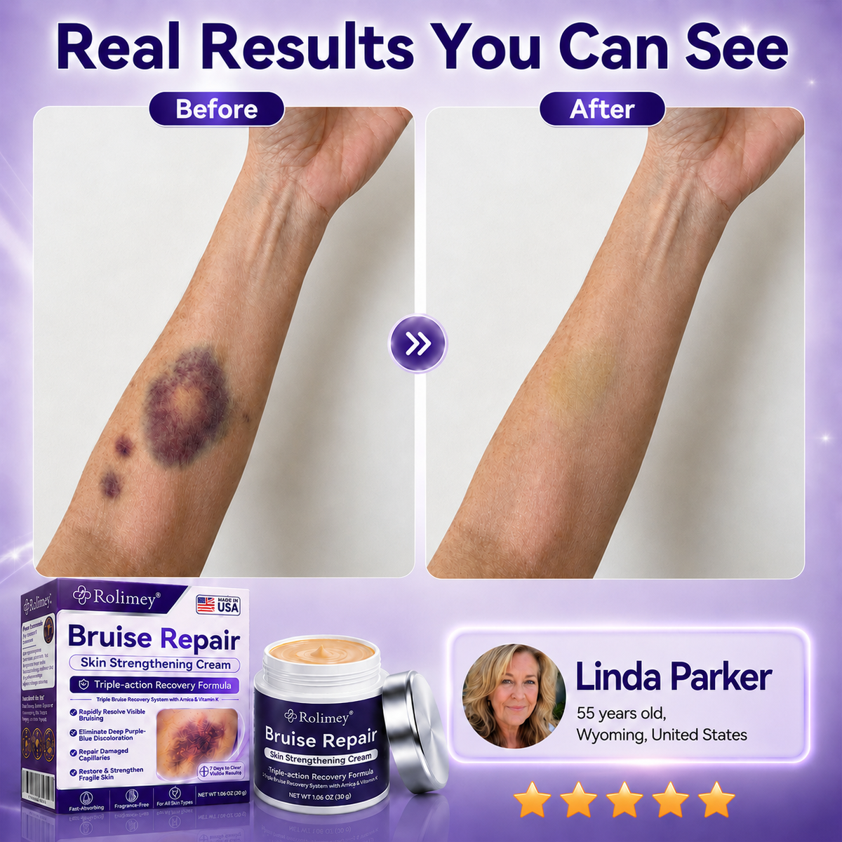 👩‍⚕️🏆Over 100,000 units sold🔥 - Rolimey® cream to repair bruises and strengthen the skin