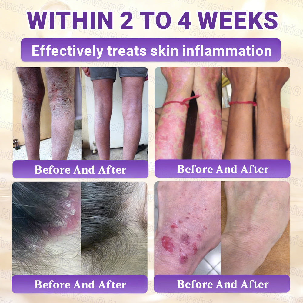 👨‍⚕️Over 100,000 units sold💕-🍁Evolvion® Biotin 10-in-1 Skin Restoration Cream