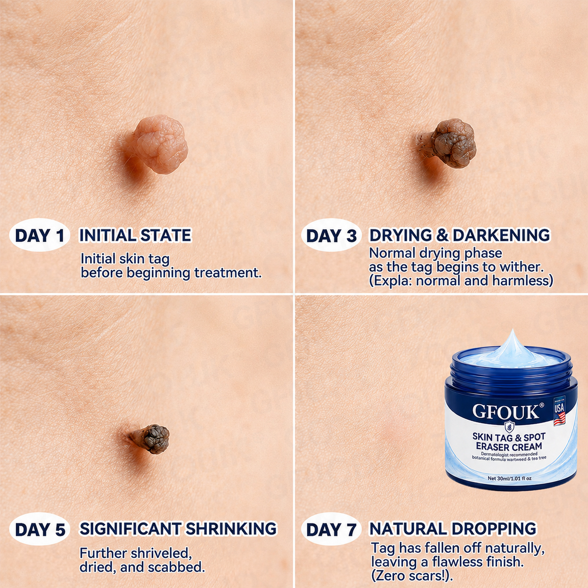 🔥Official Brand Shop |  GFOUK® 7-𝐃𝐚𝐲 𝐒𝐤𝐢𝐧 𝐓𝐚𝐠 & 𝐒𝐩𝐨𝐭 𝐄𝐫𝐚𝐬𝐞𝐫 𝐂𝐫𝐞𝐚𝐦 (Zero Pain, Zero 𝐒𝐜𝐚𝐫𝐬 Formula)